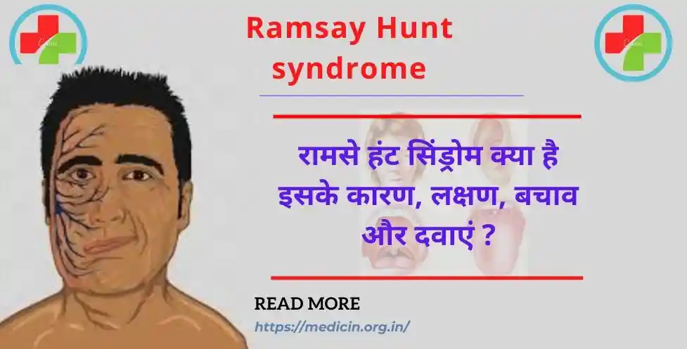 Ramsay Hunt syndrome : रामसे हंट सिंड्रोम क्या है इसके कारण, लक्षण, बचाव और दवाएं ?