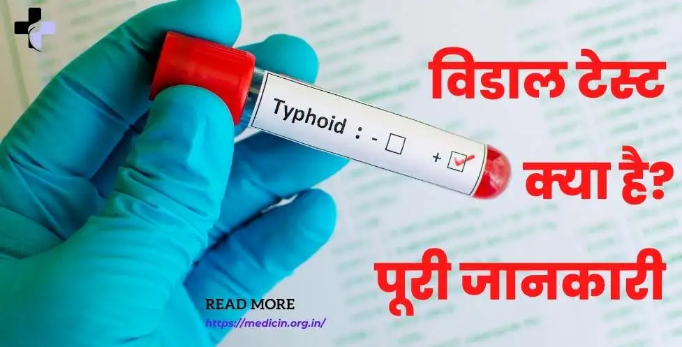 Widal test in Hindi | विडाल टेस्ट क्या है क्यों किया जाता है? सम्पूर्ण जानकारी?